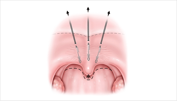 Using specially-shaped proprietary sutures, the procedure provides lift to the soft palate without surgery, thereby alleviating snoring by three mechanisms.