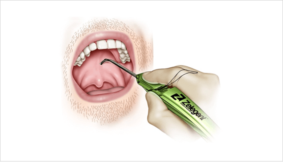 When the Elevo™ suture implant enters the soft palate, the exposed distal barbs grip the tissue around them.