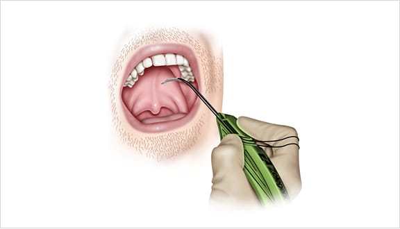 The initial insertion puncture into the soft palate is easiest when performed at a sideways slant – notice the position of the physician’s fingers