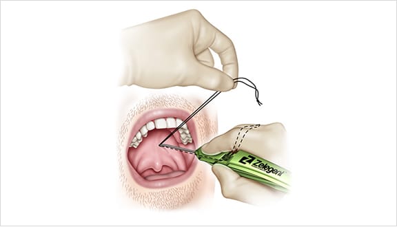 The disposable tension suture is released from the dorsal handle cleat.